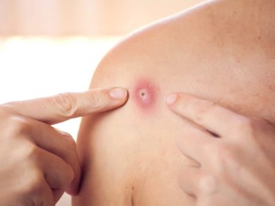 Viruela del Mono en México: Cómo se contagia y cuáles son los síntomas