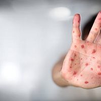 CONTAGIADERO: 11 personas con Viruela del mono en Jalisco