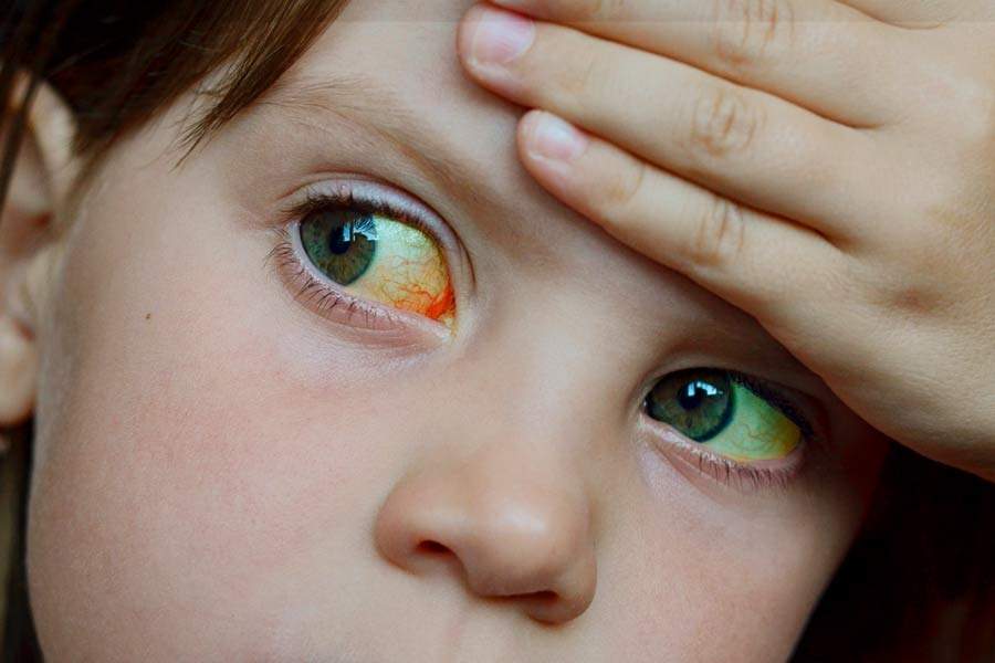 Cuáles son los síntomas de la nueva Hepatitis Infantil Aguda. Foto: Especial