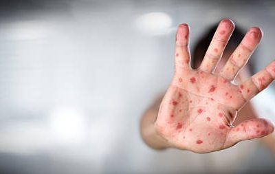 CONTAGIADERO: 11 personas con Viruela del mono en Jalisco
